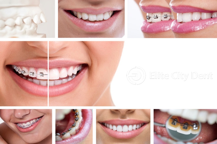 Care sunt tipurile de aparate dentare la care poți apela
