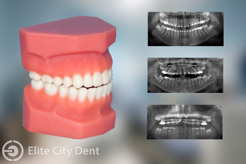 De ce este necesară chirurgia în ortodonție